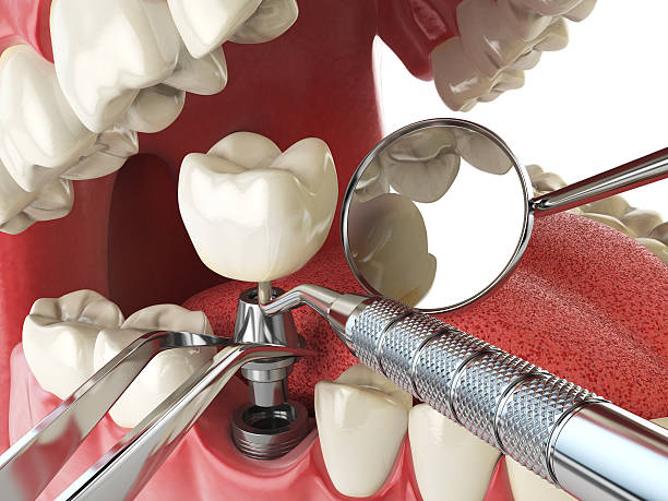 Best Emergency Wisdom Tooth Extraction in Honsville, GA